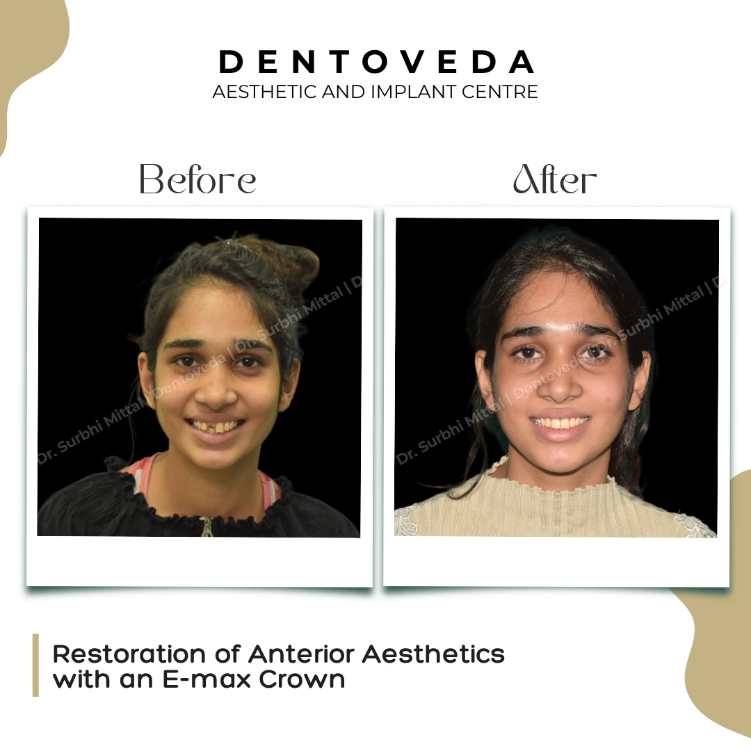 Before and after: E max Crown