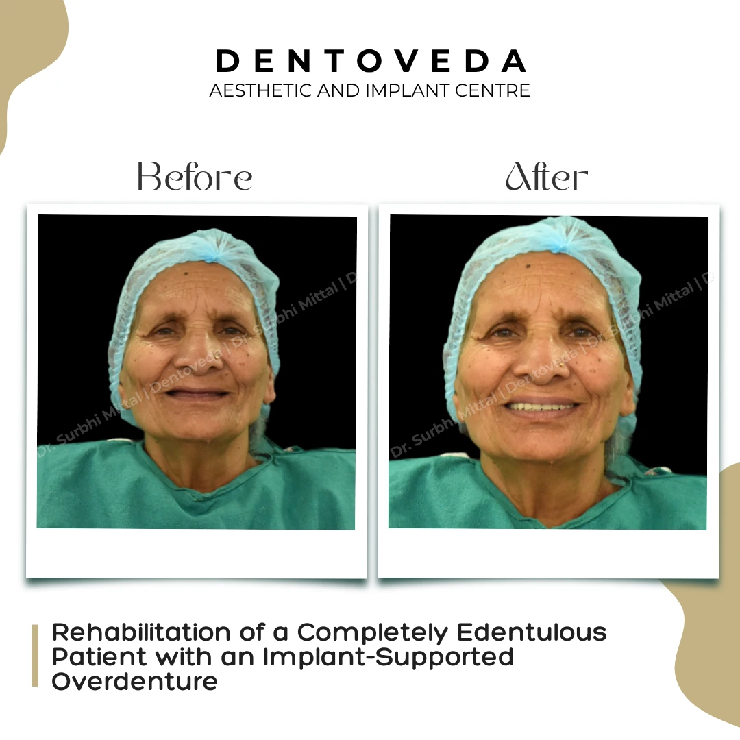 Before and after: Implant Supported Overdenture