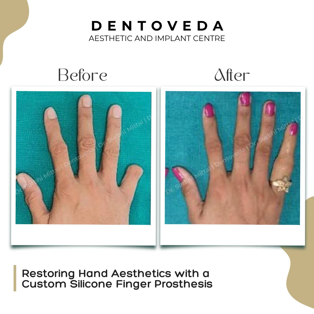 Before and after: Silicone Finger Prosthesis