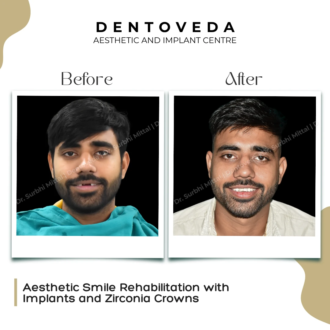 Before and after: Zirconia Crown Implant